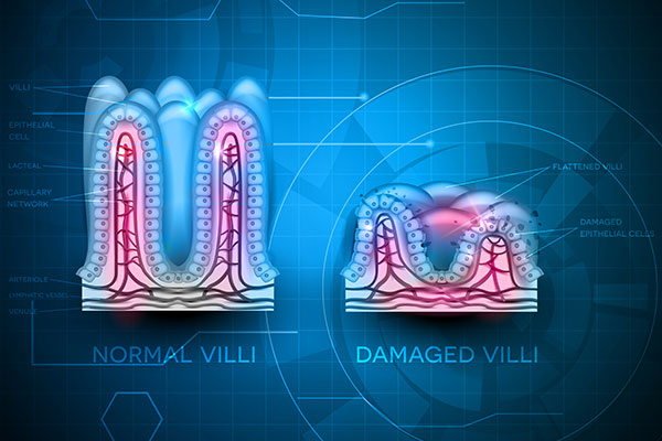 What is Celiac Disease?